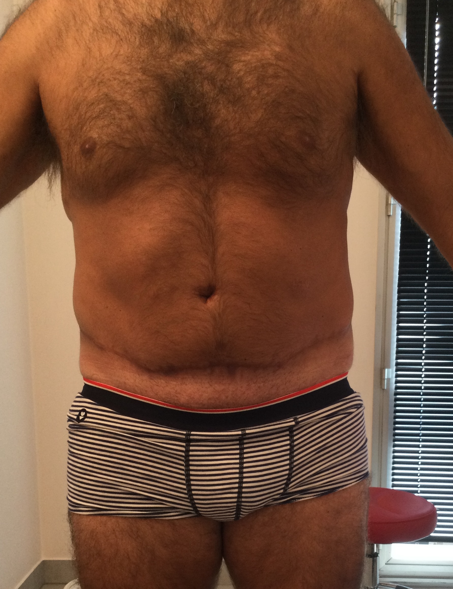 Résultat à moins d'un an après dermolipectomie abdominale circulaire