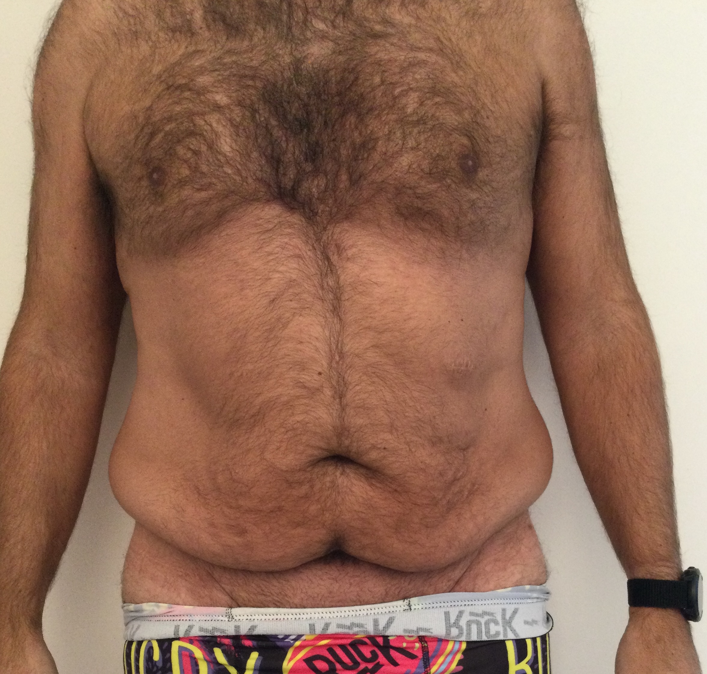 Tablier abdominal après BYPASS