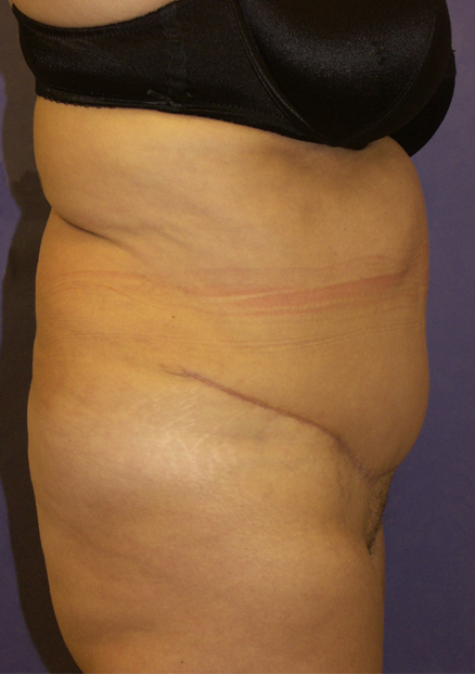 Patiente d'âge moyen. Vrai "tablier" abdominal secondaire aux grossesses.