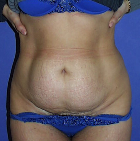 Abdominoplastie avec transposition du nombril, liposuccion et réparation des muscles abdominaux.