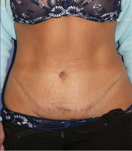 Abdominoplastie avec transposition du nombril, liposuccion et réparation des muscles abdominaux.