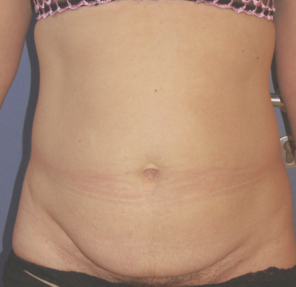Lifting du ventre (mini abdominoplastie). Résultat à plus d'un an.