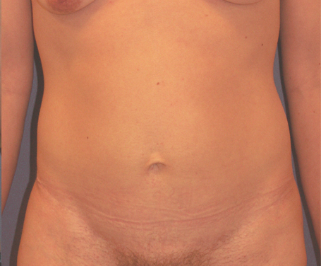 Lifting du ventre (mini abdominoplastie). Résultat à plus d'un an.