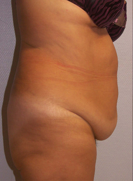 Patiente d'âge moyen. Vrai "tablier" abdominal secondaire aux grossesses.