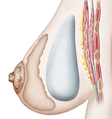 Augmentation volume des seins