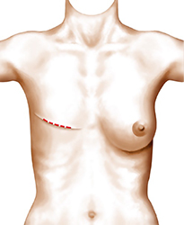 Reconstruction mammaire par prothèses