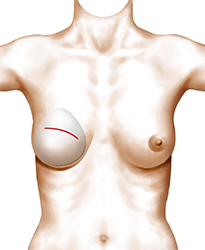 Reconstruction mammaire prothèses