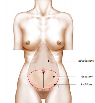 Abdominoplastie