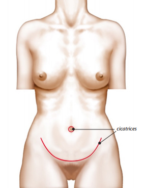 Chirurgie silhouette abdominoplastie