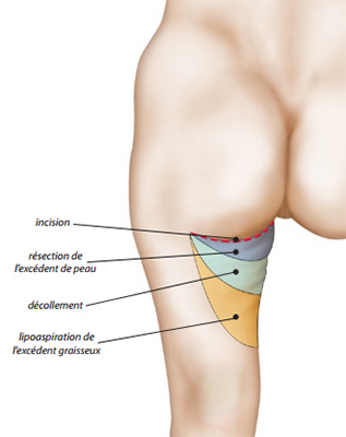 Lifting cuisses