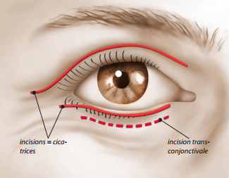 Chirurgie paupières Blépharoplastie