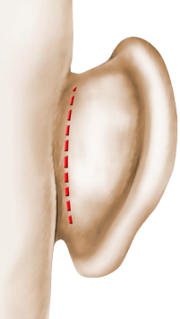 Otoplastie oreilles décolées